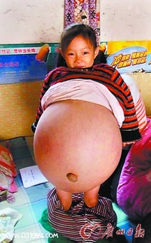山西4歲女孩患恐怖腹水腫腹大如球 今赴京醫病