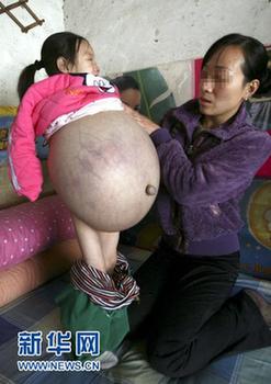 山西4歲女孩患恐怖腹水腫腹大如球 今赴京醫病