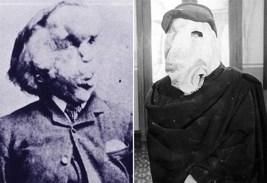 醫(yī)學(xué)“考古”將揭秘英國大象人怪癥[圖]