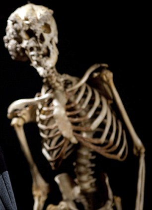 醫(yī)學(xué)“考古”將揭秘英國大象人怪癥[圖]