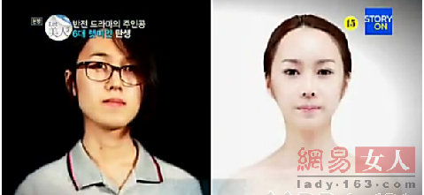 丑女變靚妹！韓國整容節目爆紅