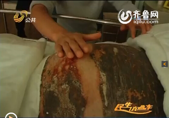 濰坊24歲準(zhǔn)媽媽全身90%燒傷 丈夫婆婆離世為愛(ài)堅(jiān)強(qiáng)保胎