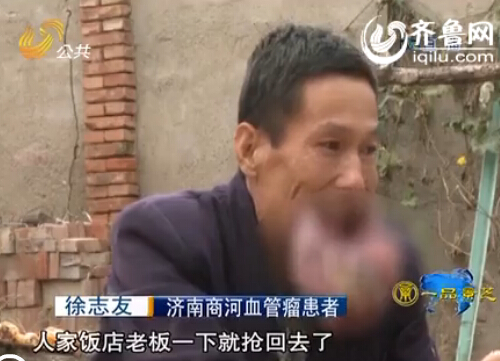 濟南：男子嘴唇長瘤50年未醫治 唇部腫脹比臉大