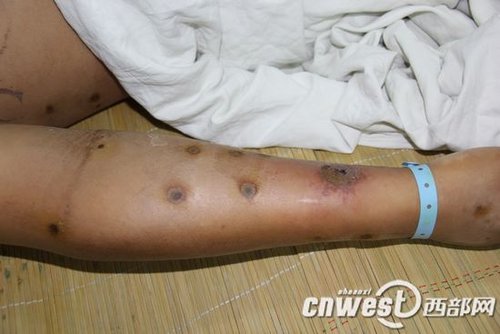 陜西安康數百人被毒蜂蜇傷 農婦稻田邊被蜇200針