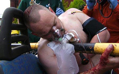 英司機被鐵桿穿胸 鎮定報警救援及時奇跡生還