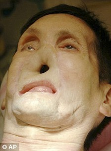 美國第二位“換臉”人術(shù)后現(xiàn)身 對新生活充滿希冀