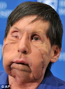 美國第二位“換臉”人術(shù)后現(xiàn)身 對新生活充滿希冀