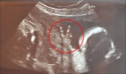 世界上最自信的寶寶　媽媽肚中比出完美V字勝利手勢